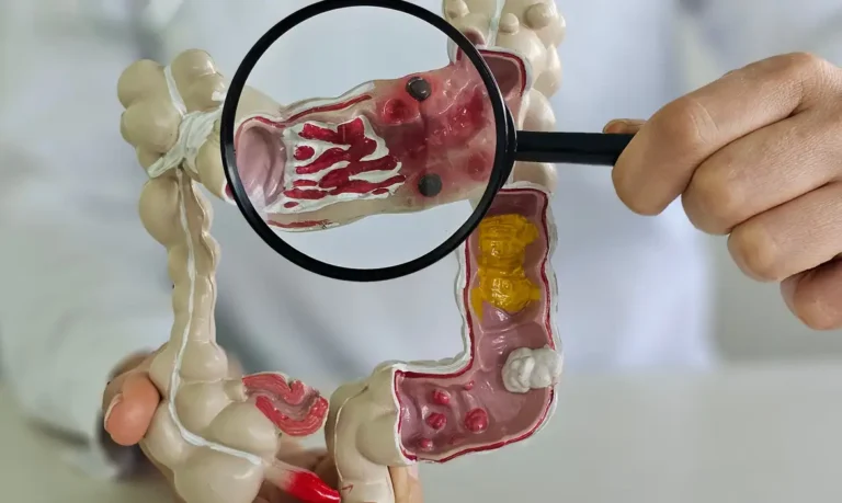 Doenças inflamatórias intestinais aumentam cinco vezes no Brasil em 13 anos, aponta estudo